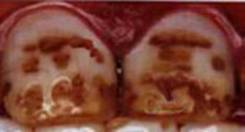 fluorosi macchie denti dentista sbiancamento dentale professionale